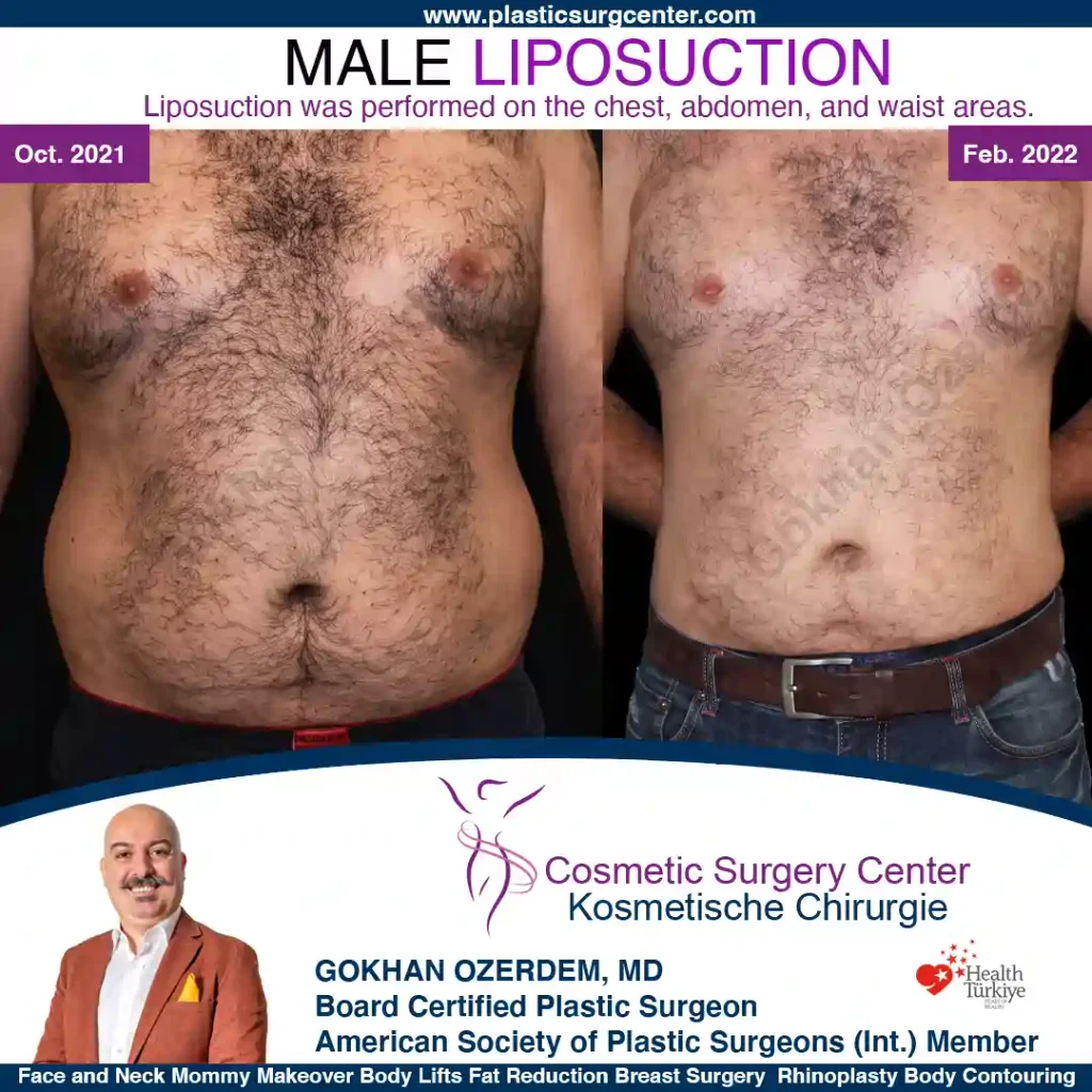 Thigh liposuction in turkey, Antalya - Case 7 - Front View