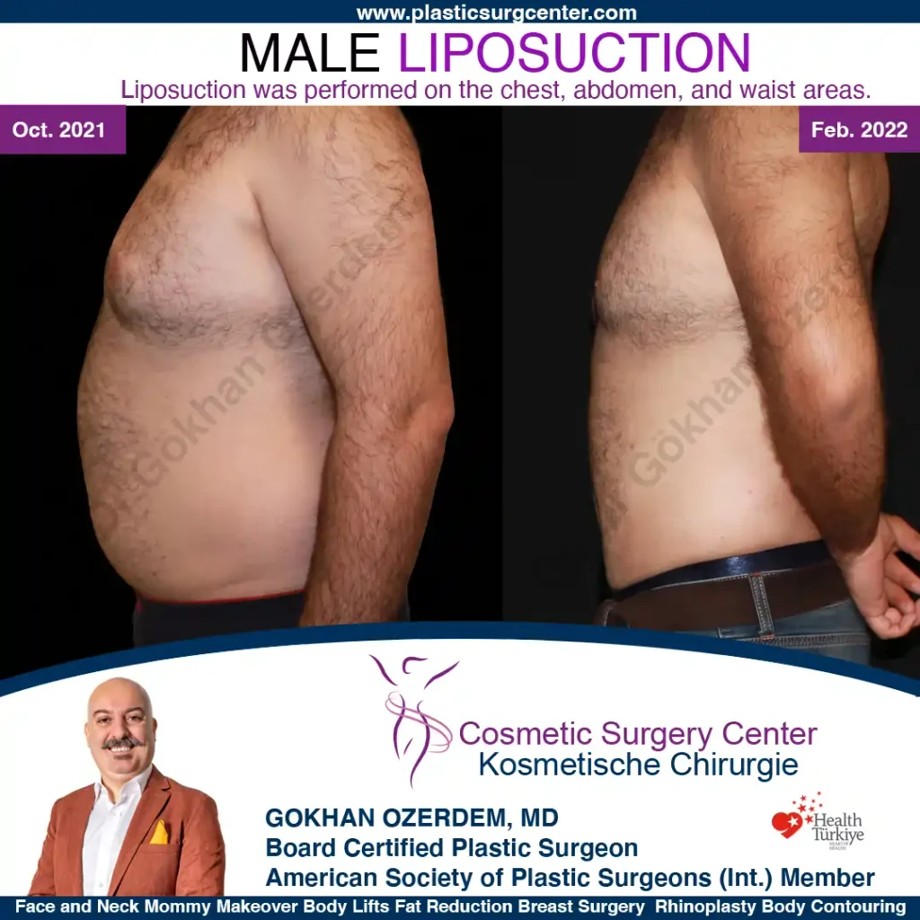Thigh liposuction in turkey, Antalya - Case 7 - Left Side View