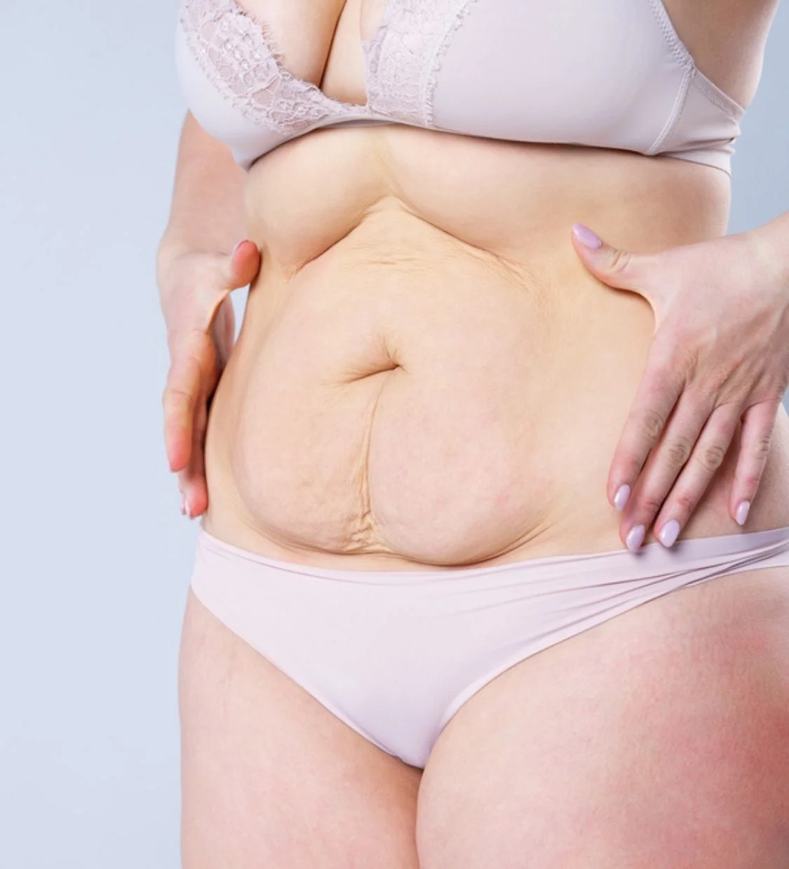 Mini tummy tuck in turkey, Antalya