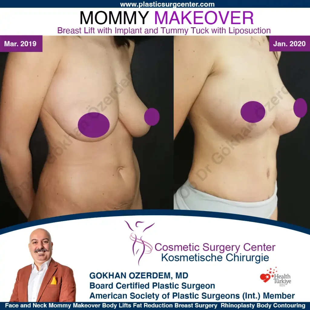 Mommy Makeover in Turkey, Antalya Case 14 Breast Lift Tummy Tuck Oblique View