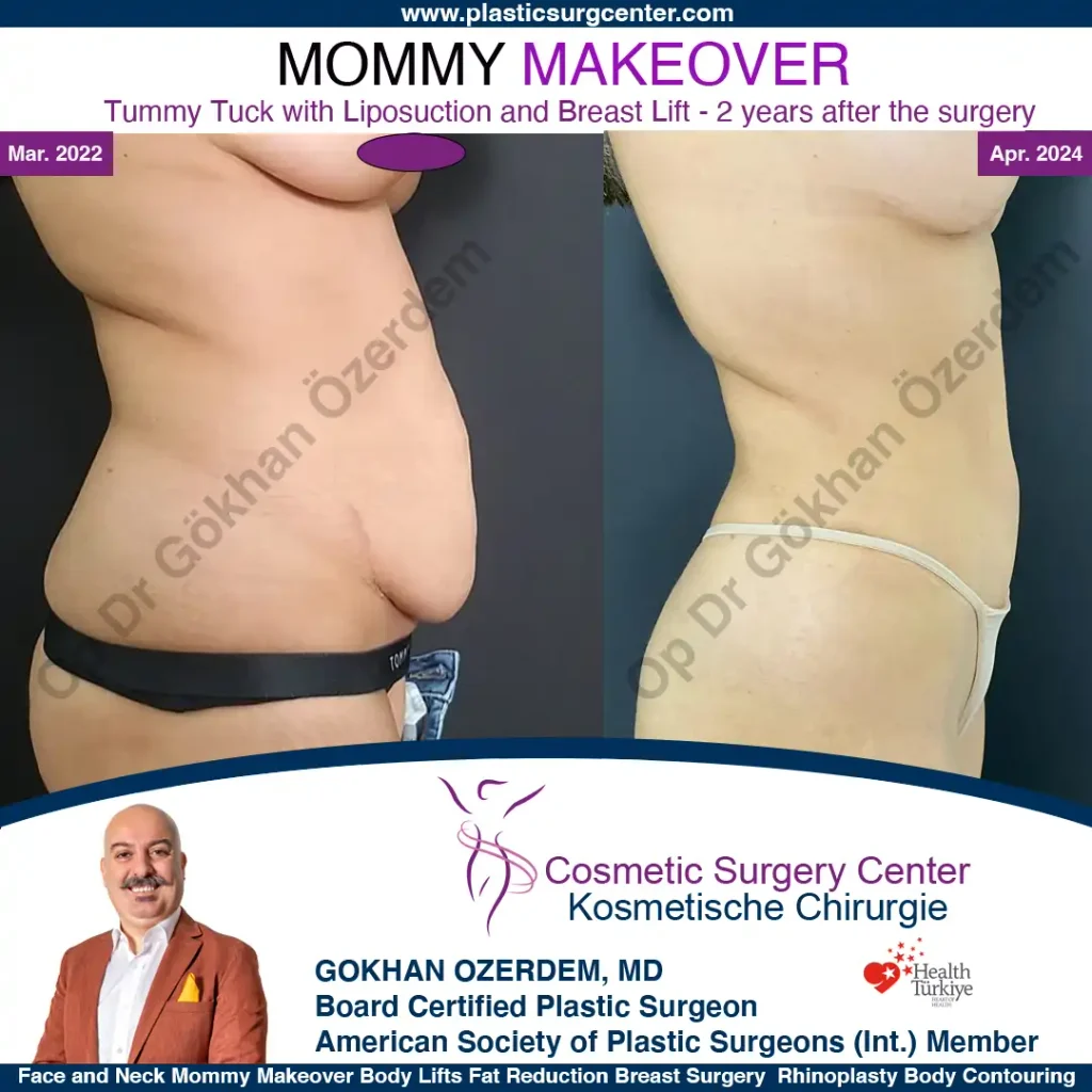 Mommy Makeover in Turkey, Antalya Case 2 Tummy Tuck Side