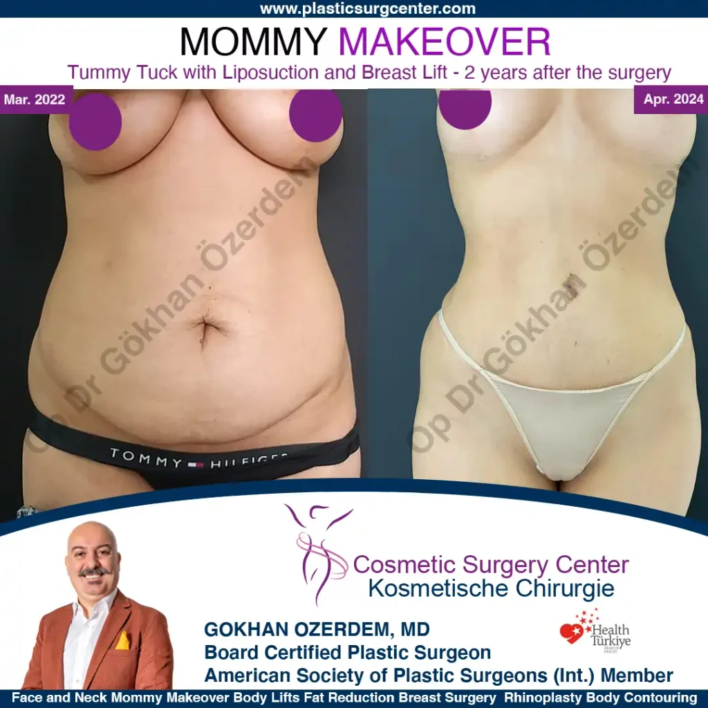 Mommy Makeover in Turkey, Antalya Case 2 Tummy Tuck Front