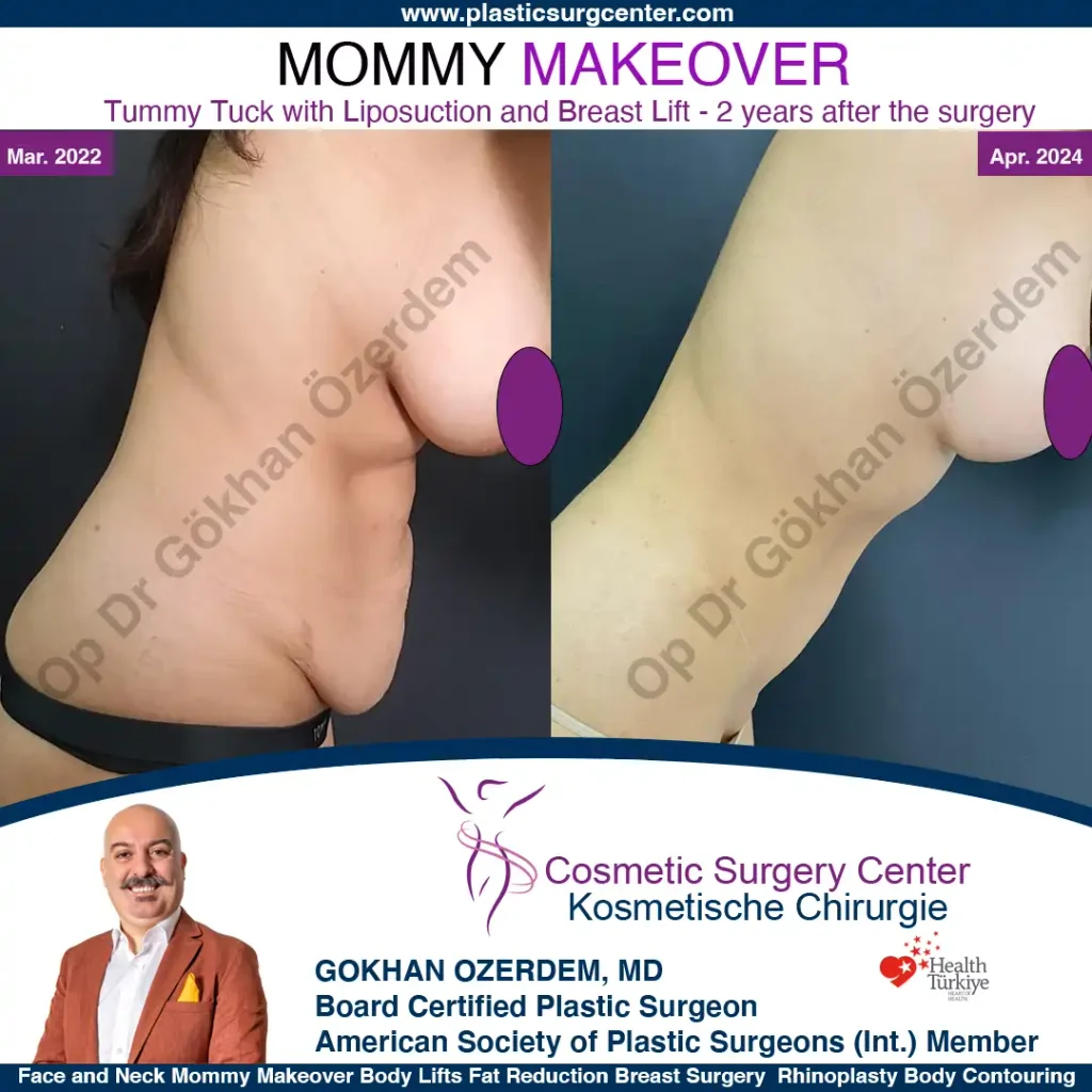 Mommy Makeover in Turkey, Antalya Case 2 Tummy Tuck