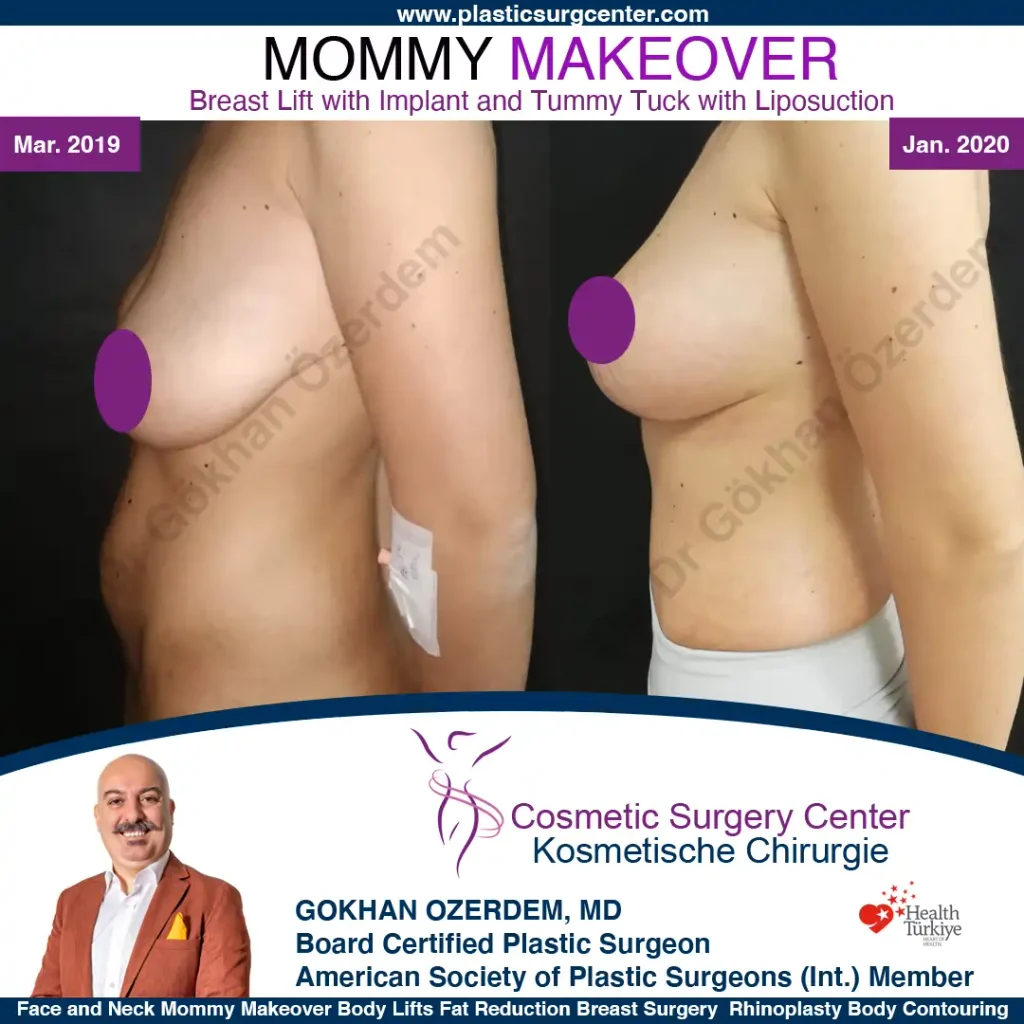 Mommy Makeover in Turkey, Antalya Case 14 Breast Lift Tummy Tuck left Side