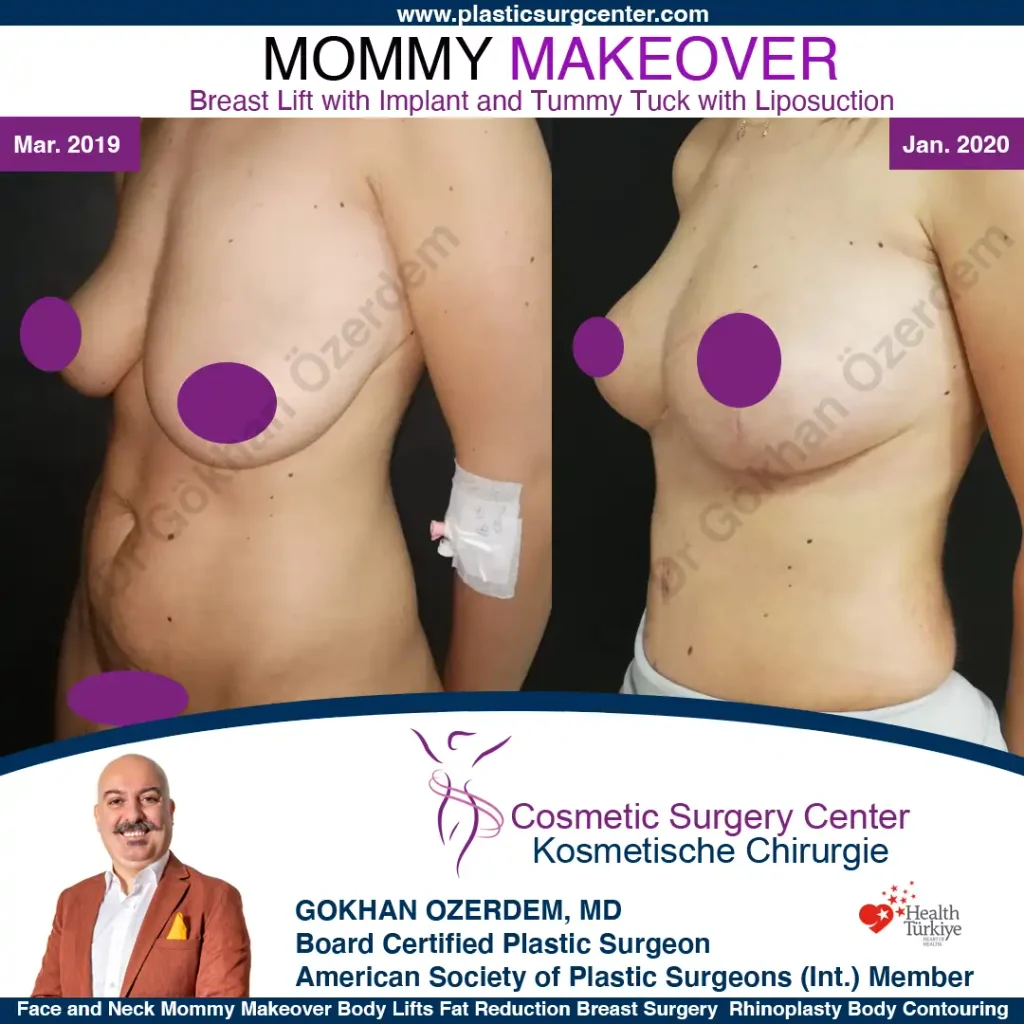 Mommy Makeover in Turkey, Antalya Case 14 Breast Lift Tummy Tuck Oblique View 2