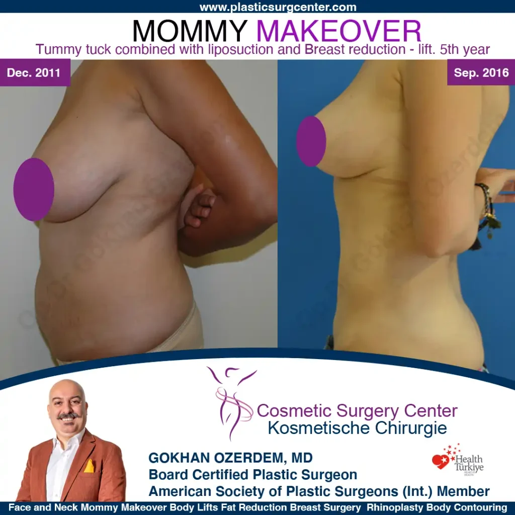 Mommy Makeover in Turkey, Antalya Case 15 Breast Reduction Tummy Tuck Left Side