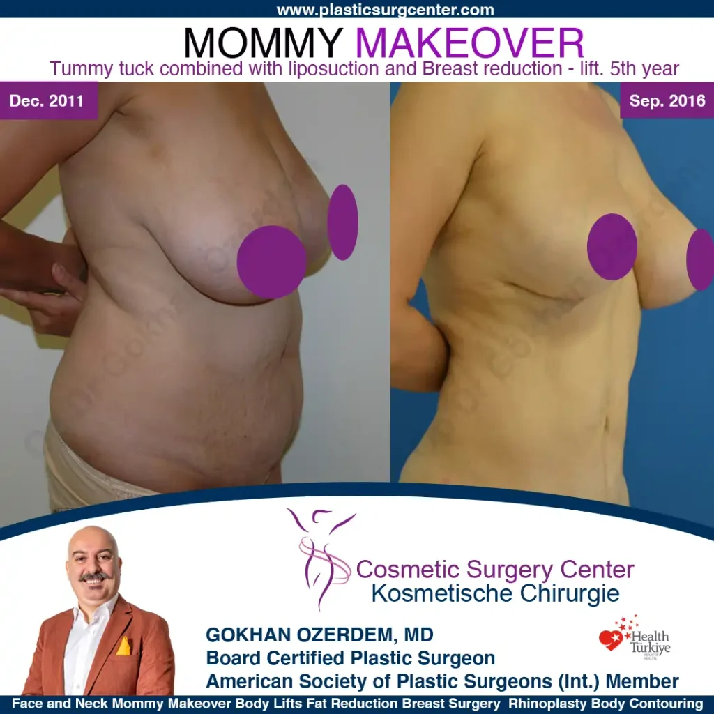 Mommy Makeover in Turkey, Antalya Case 15 Breast Reduction Tummy Tuck Oblique View 1