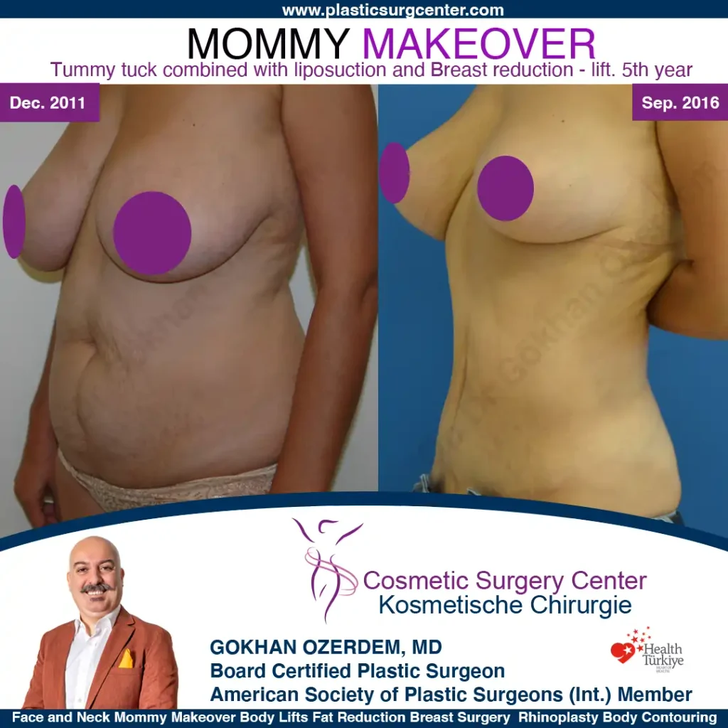 Mommy Makeover in Turkey, Antalya Case 15 Breast Reduction Tummy Tuck Oblique View 2