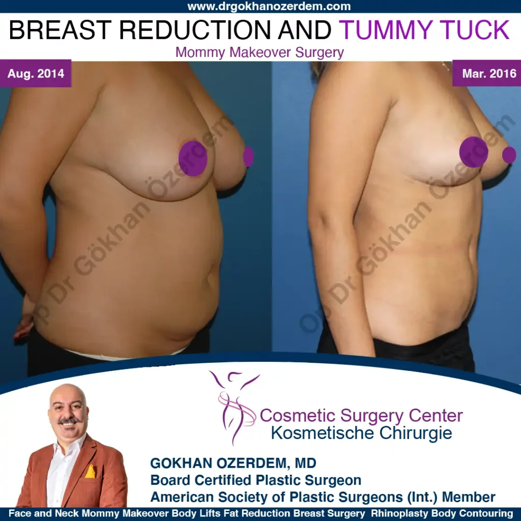 Breast Reduction in Turkey, Case 2 - Right Oblique View