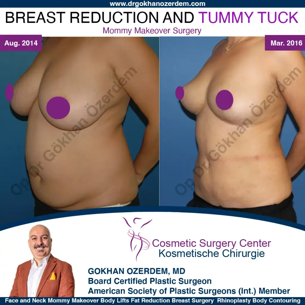 Breast Reduction in Turkey, Case 2 - Oblique View