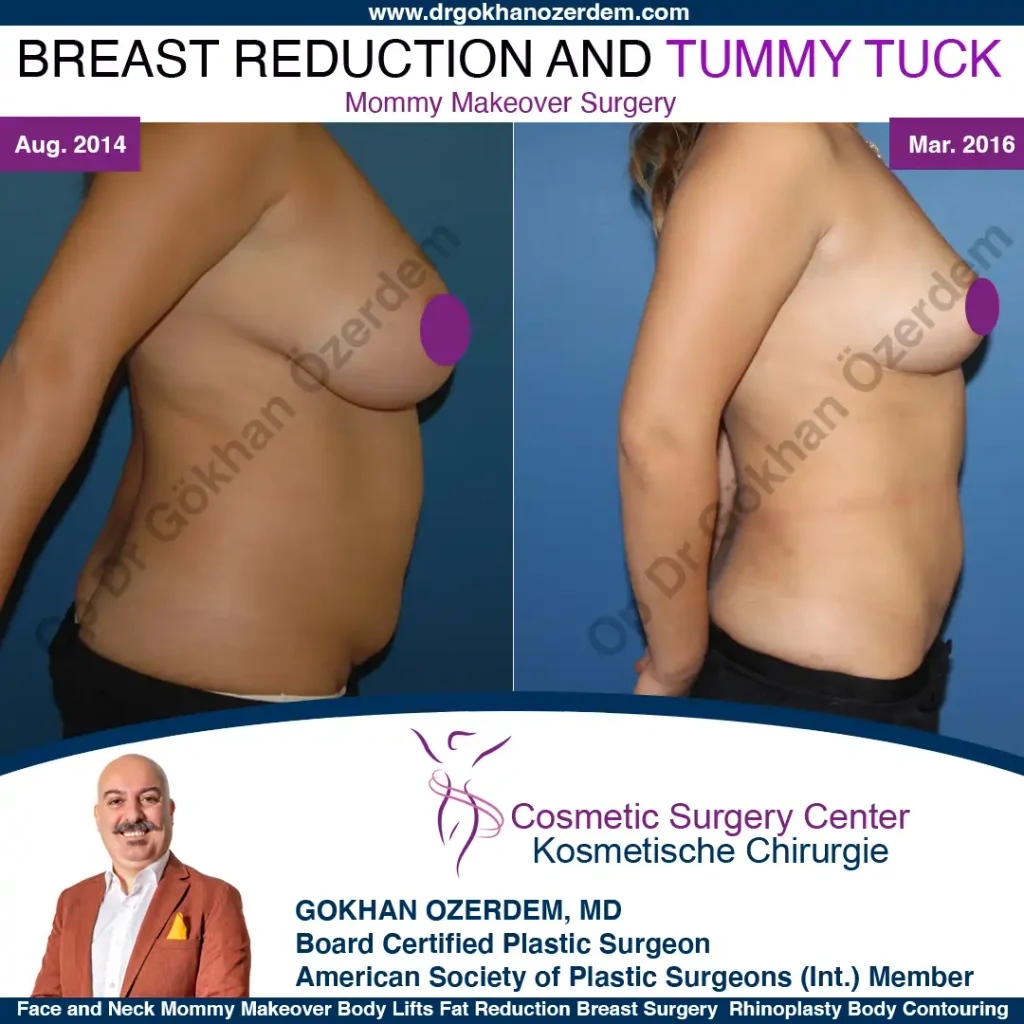 Breast Reduction in Turkey, Case 2 - Right Side