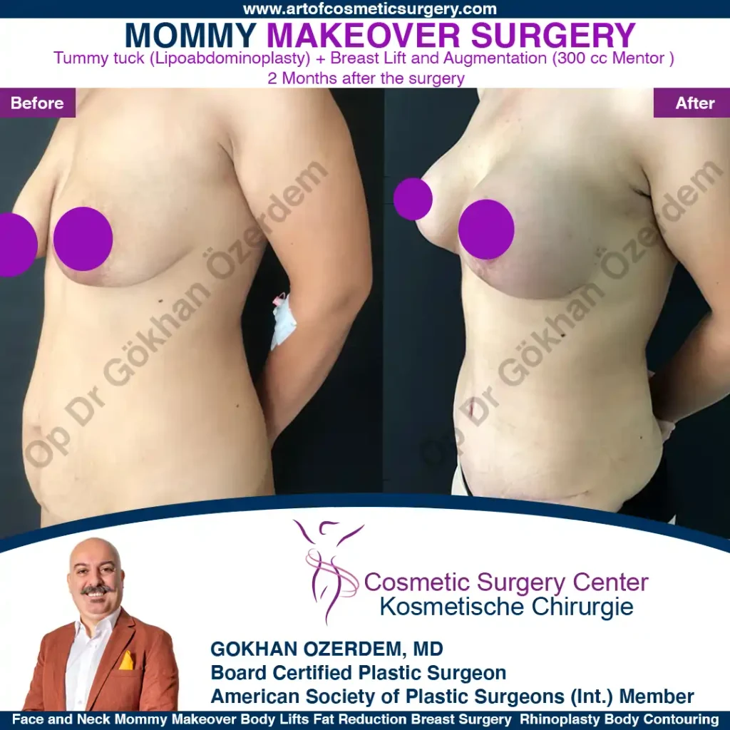 Breast Lift in Turkey, Case 1 - Oblique View