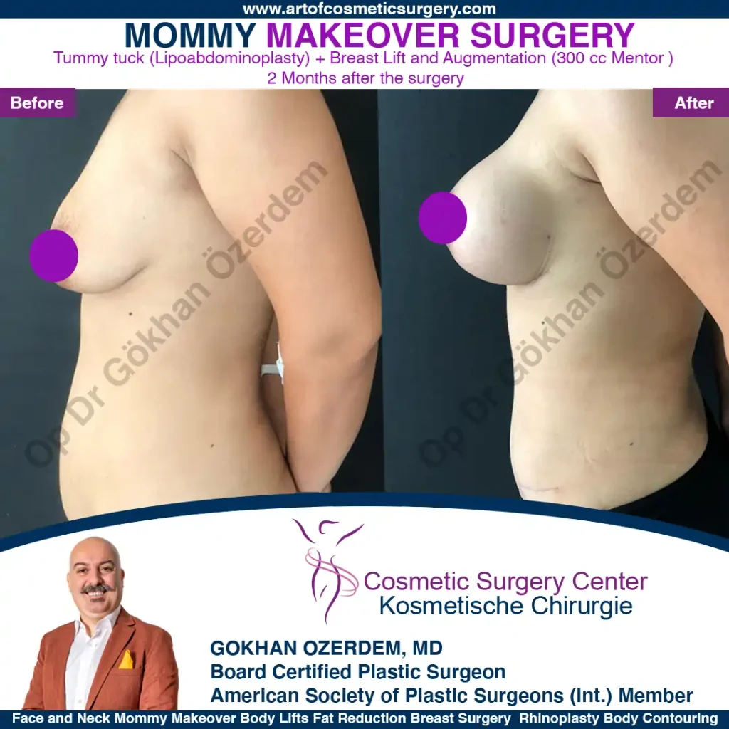 Breast Lift in Turkey, Case 1 - Left View