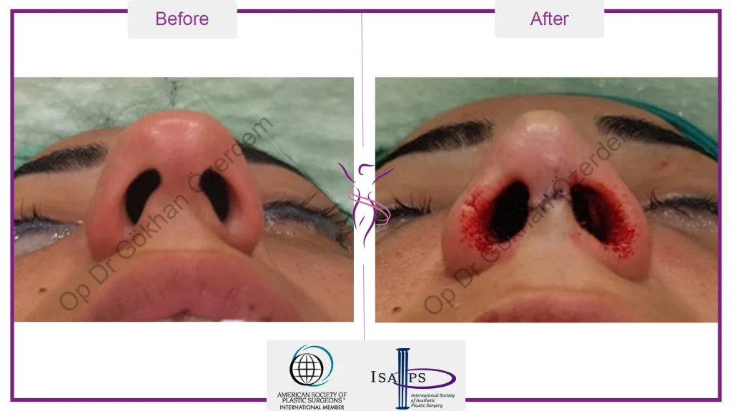 Rhinoplasty in Turkey - Case 19 - Female - Base View