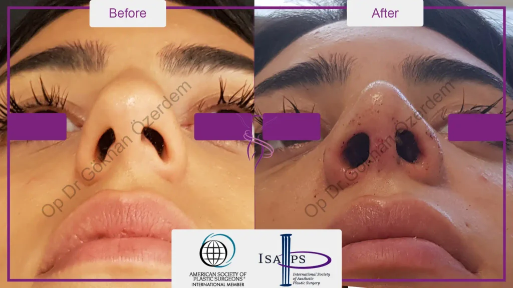 Rhinoplasty in Turkey - Case 20 - Female - Base View