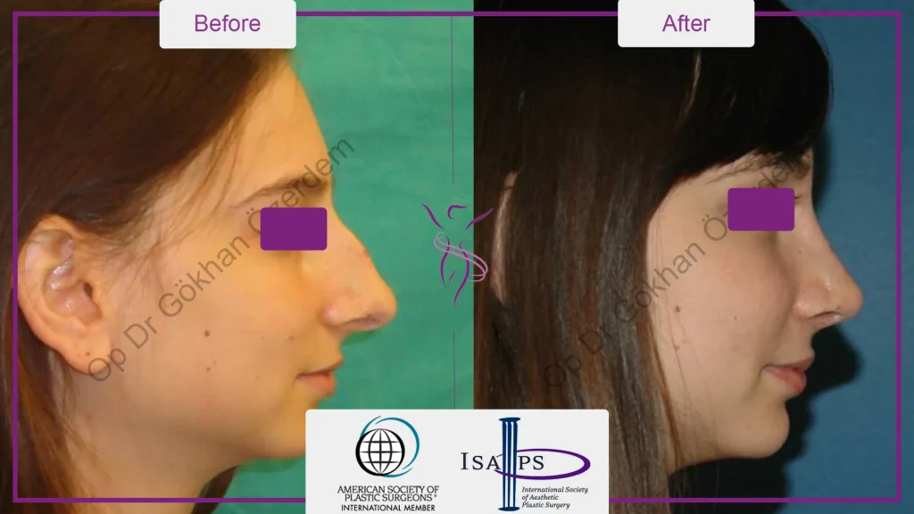 Rhinoplasty in Turkey - Case 18 - Female - Right Profile
