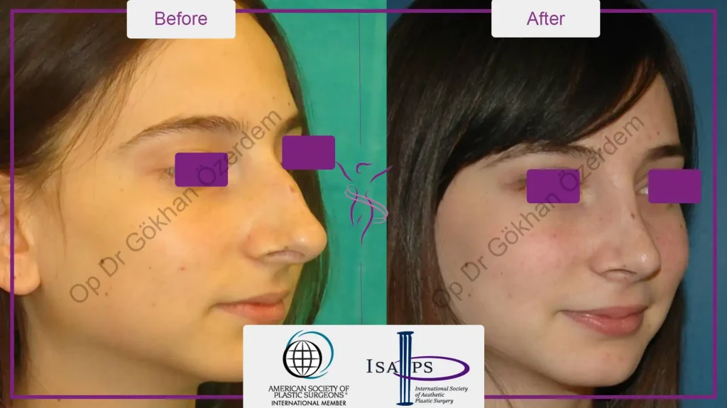 Rhinoplasty in Turkey - Case 18 - Female - Oblique View