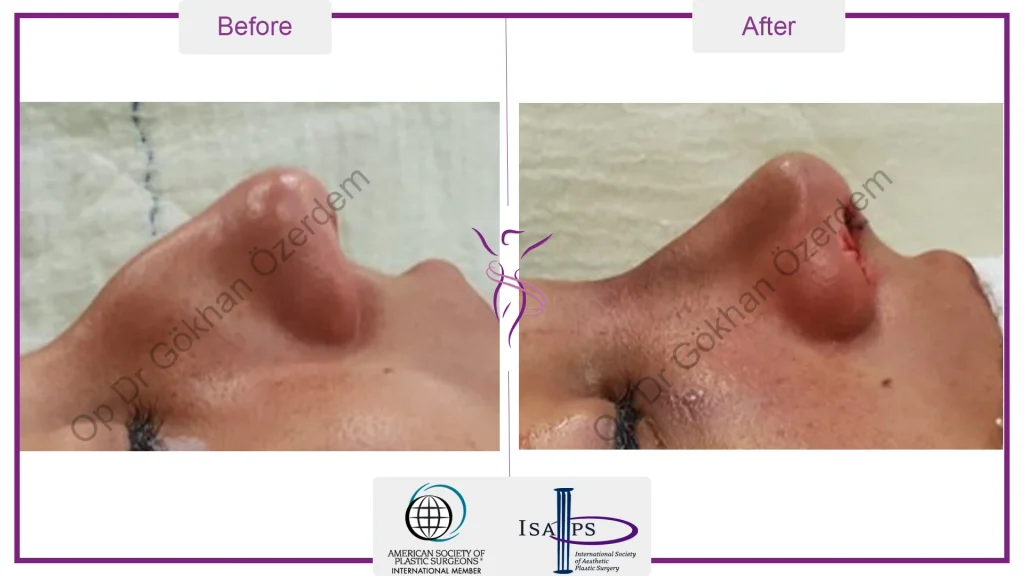 Rhinoplasty in Turkey - Case 19 - Female - Right Profile
