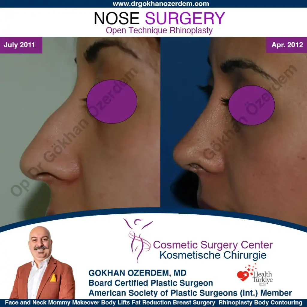 Rhinoplasty in Turkey - Case 5 - Female - Left Profile