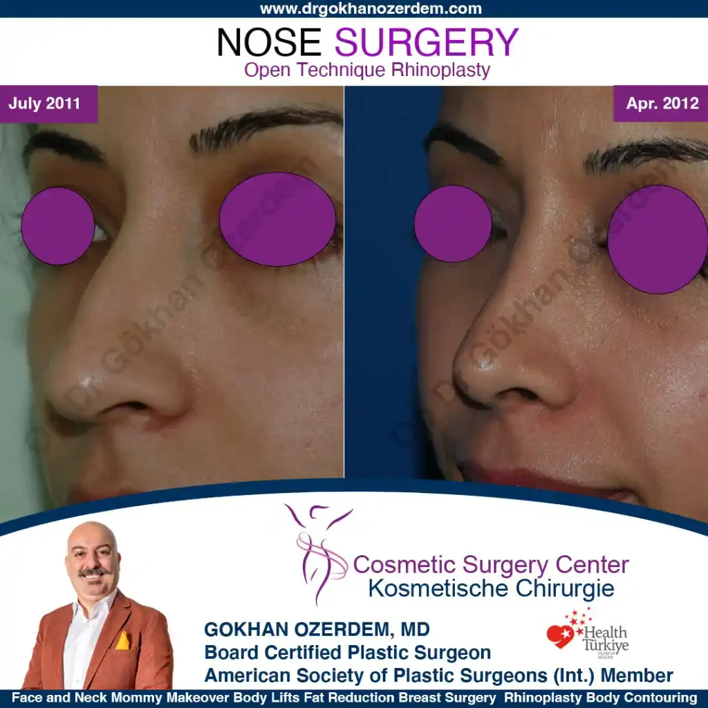 Rhinoplasty in Turkey - Case 5 - Female - Oblique view