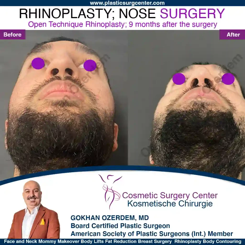 Rhinoplasty in Turkey - Case 4 - Male - Base View