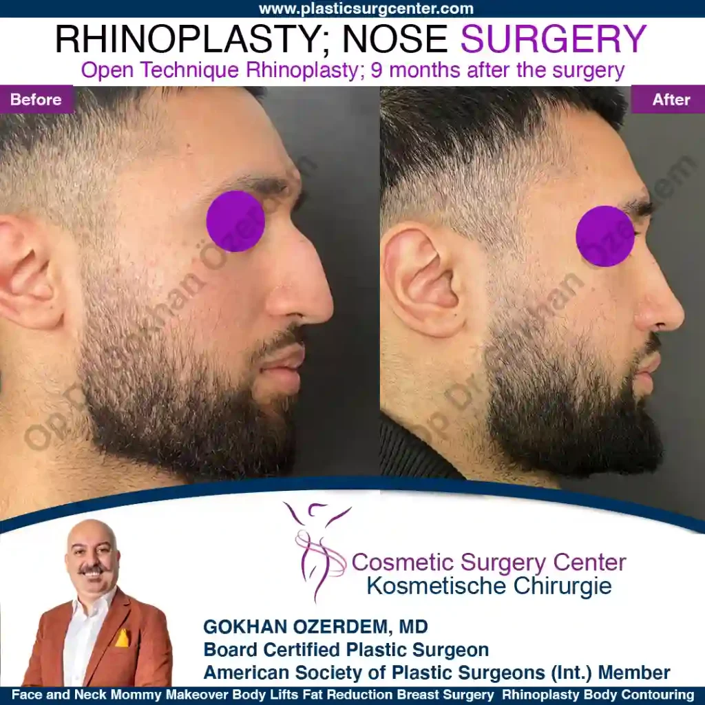 Rhinoplasty in Turkey - Case 4 - Make - Right Profile