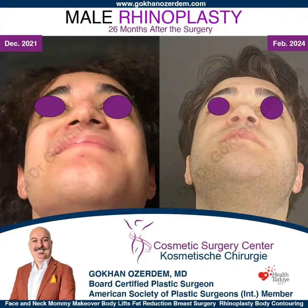 Rhinoplasty in Turkey - Case 2 - Male - Base View