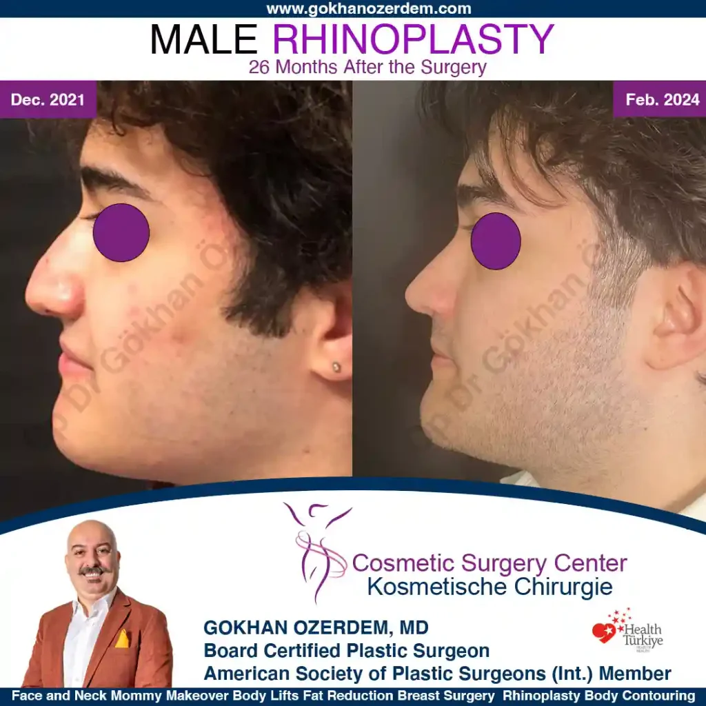 Rhinoplasty in Turkey - Case 2 - Male - Left Profile