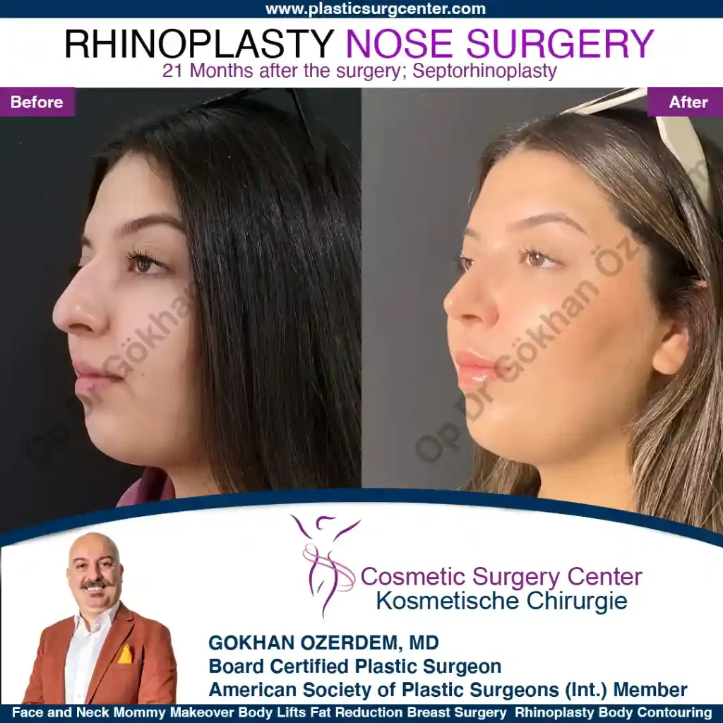 Rhinoplasty in Turkey - Case 1 - Female - Oblique