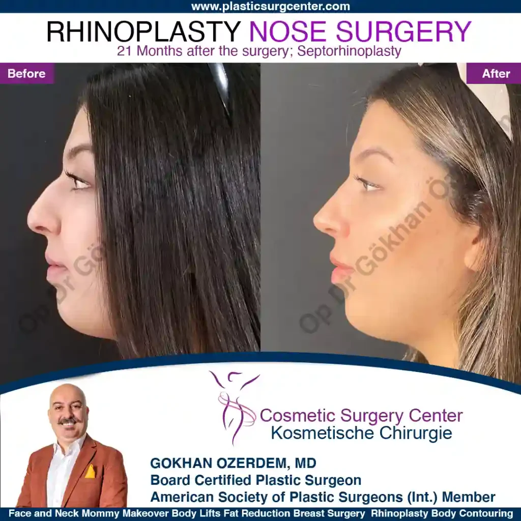 Rhinoplasty in Turkey - Case 1 - Female - Left Profile