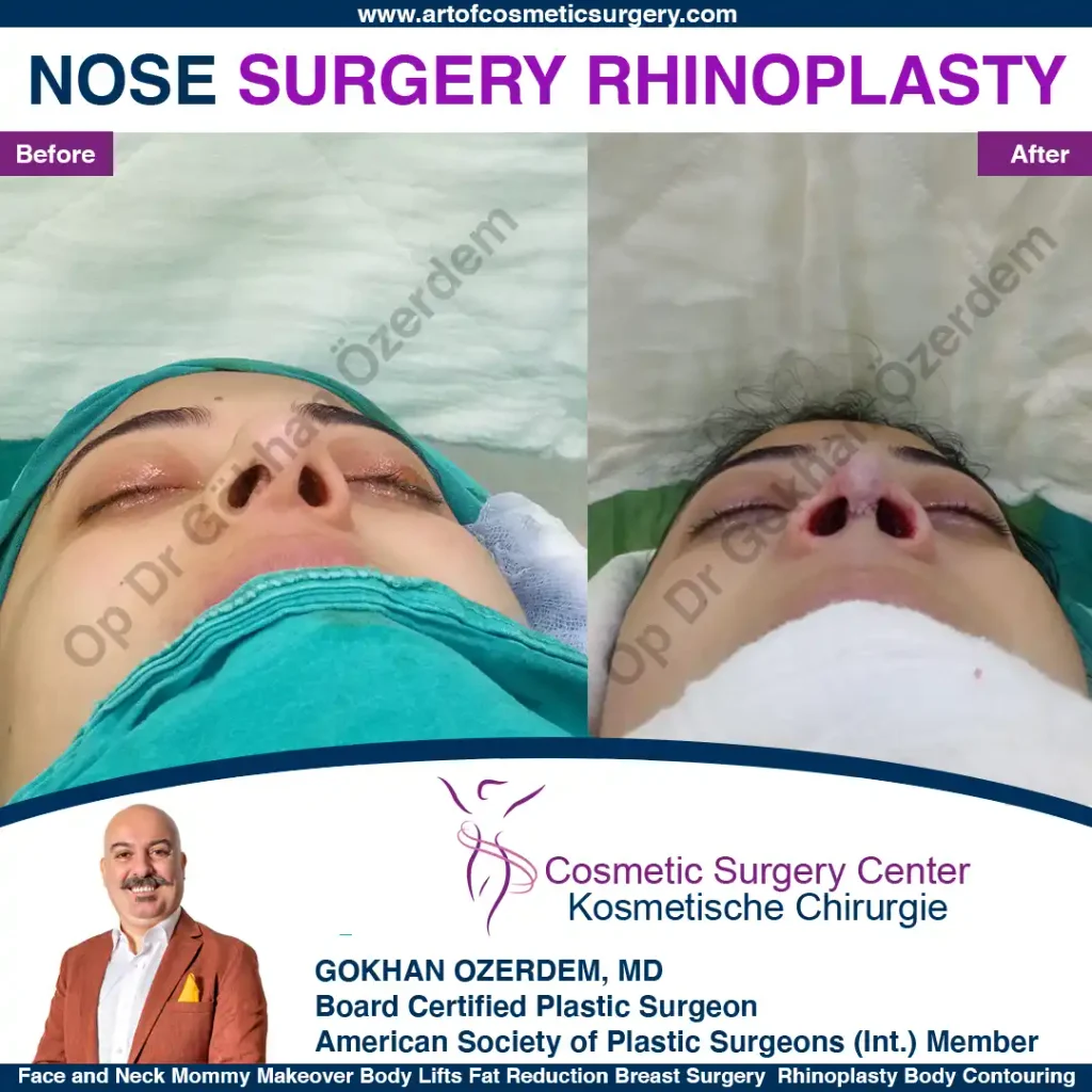 Rhinoplasty in Turkey - Case 17 - Female - Base View