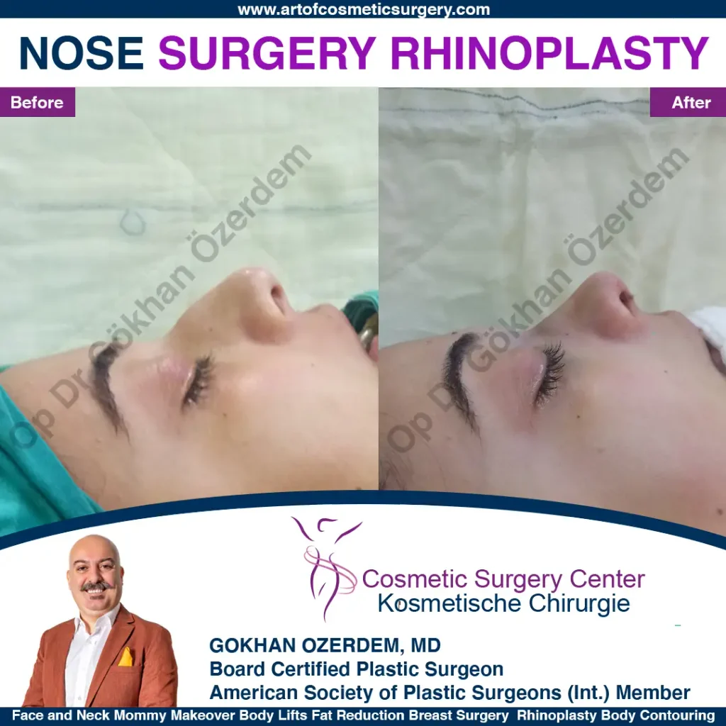 Rhinoplasty in Turkey - Case 17 - Female - Right Profile