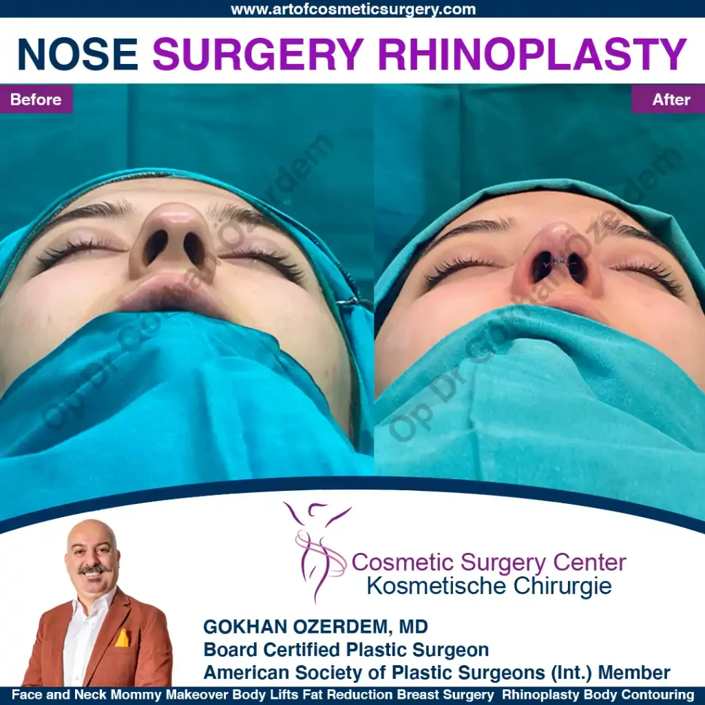 Rhinoplasty in Turkey - Case 16 - Female - Base View