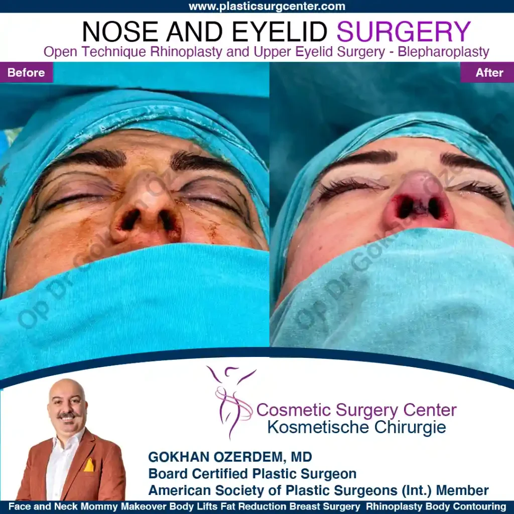 Rhinoplasty in Turkey - Case 15 - Female - Base View