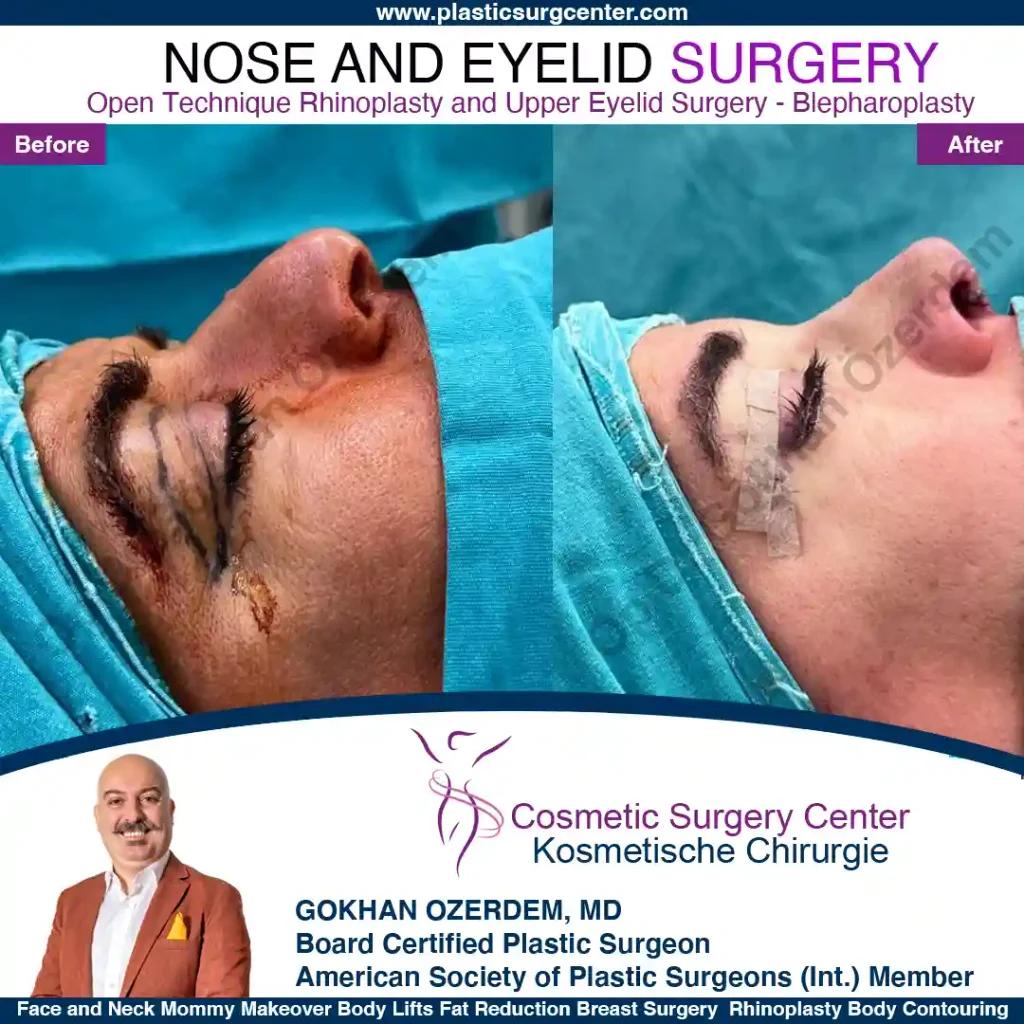 Rhinoplasty in Turkey - Case 15 - Female - Right Profile
