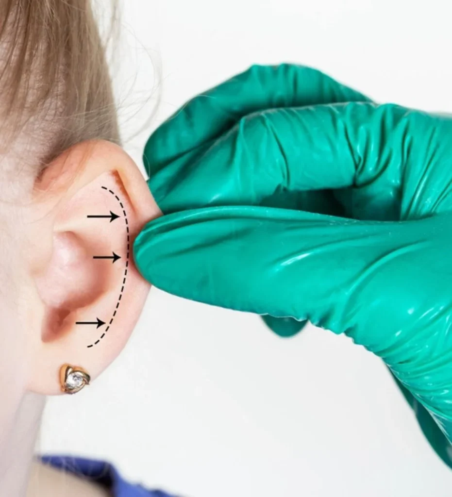 Otoplasty in Turkey Antalya