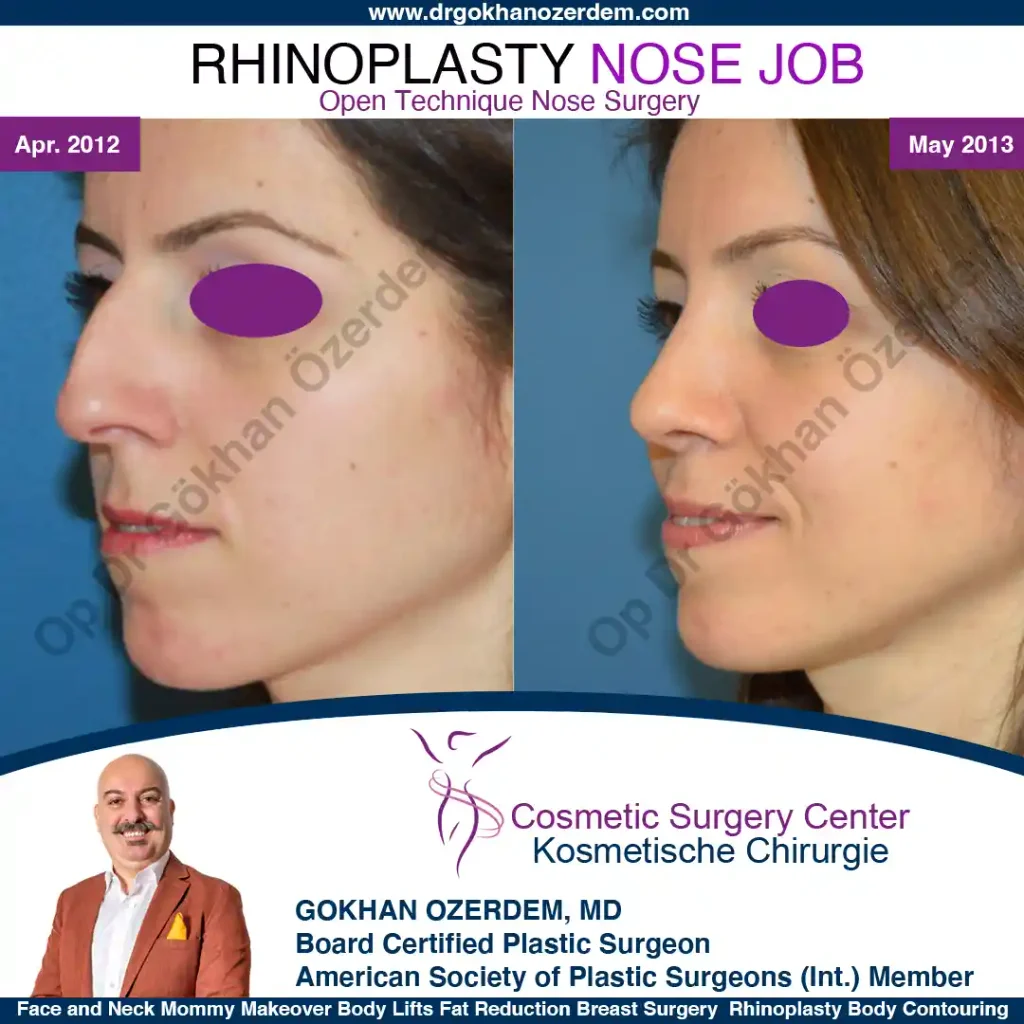 Rhinoplasty in Turkey - Case 3 - Female - Oblique view
