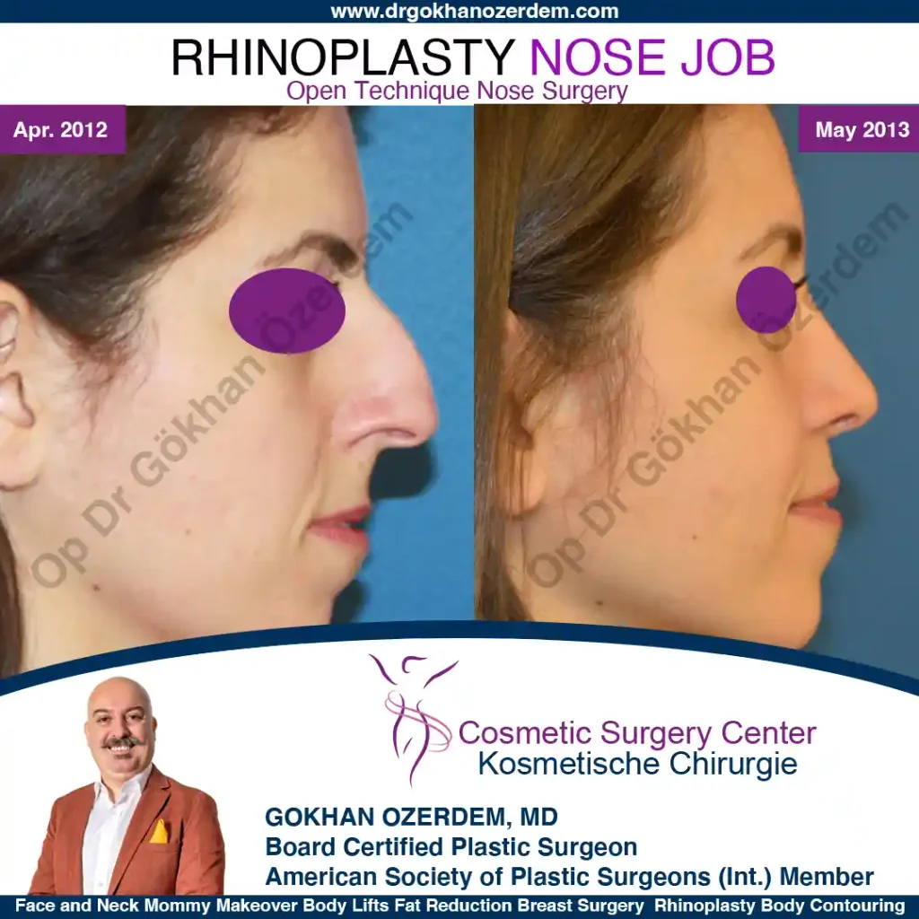 Rhinoplasty in Turkey - Case 3 - Female - Right Profile