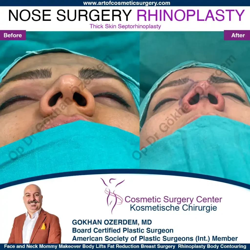 Rhinoplasty in Turkey - Case 14 - Female - Base view