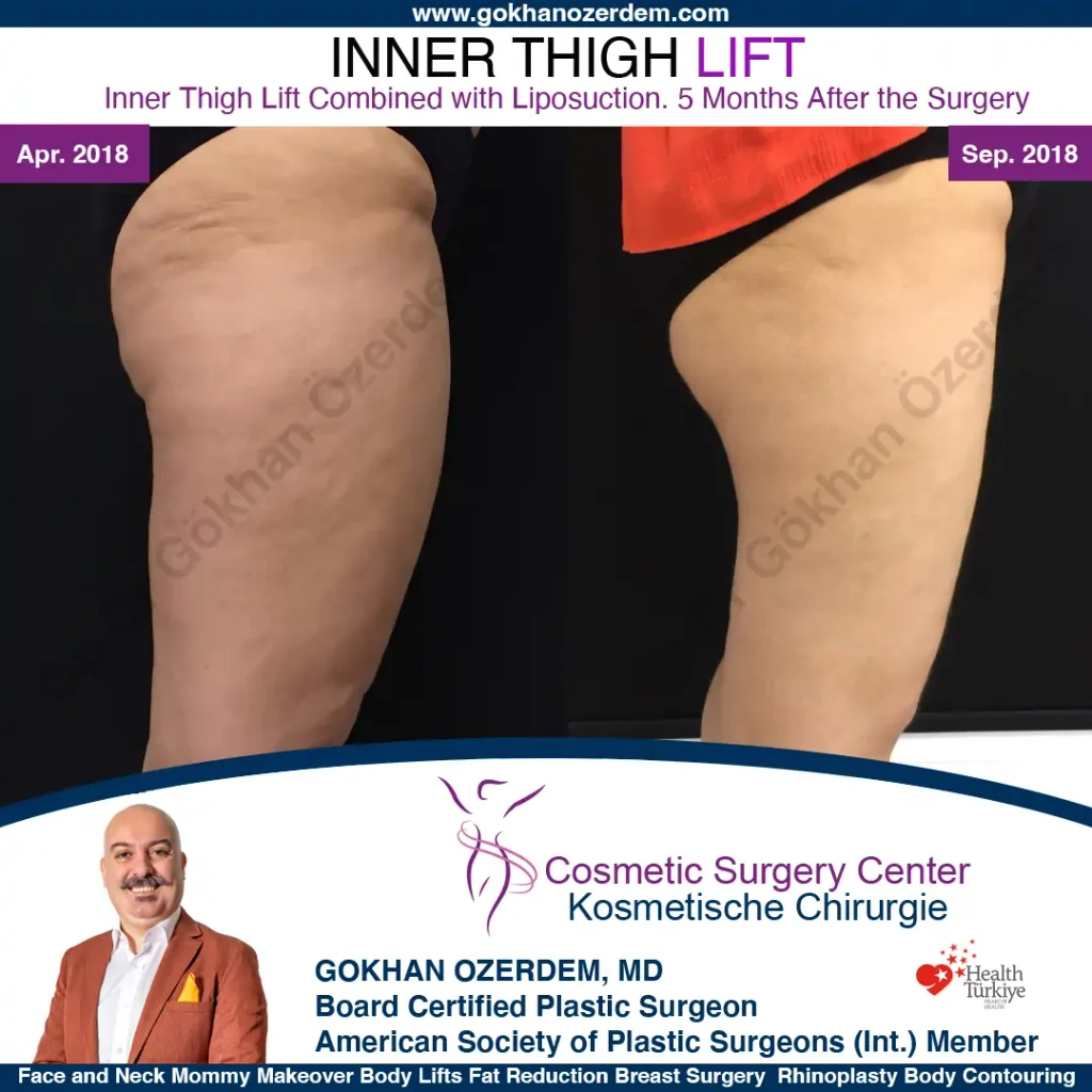 Inner Thigh Lift in Turkey, Case 1 - Side View