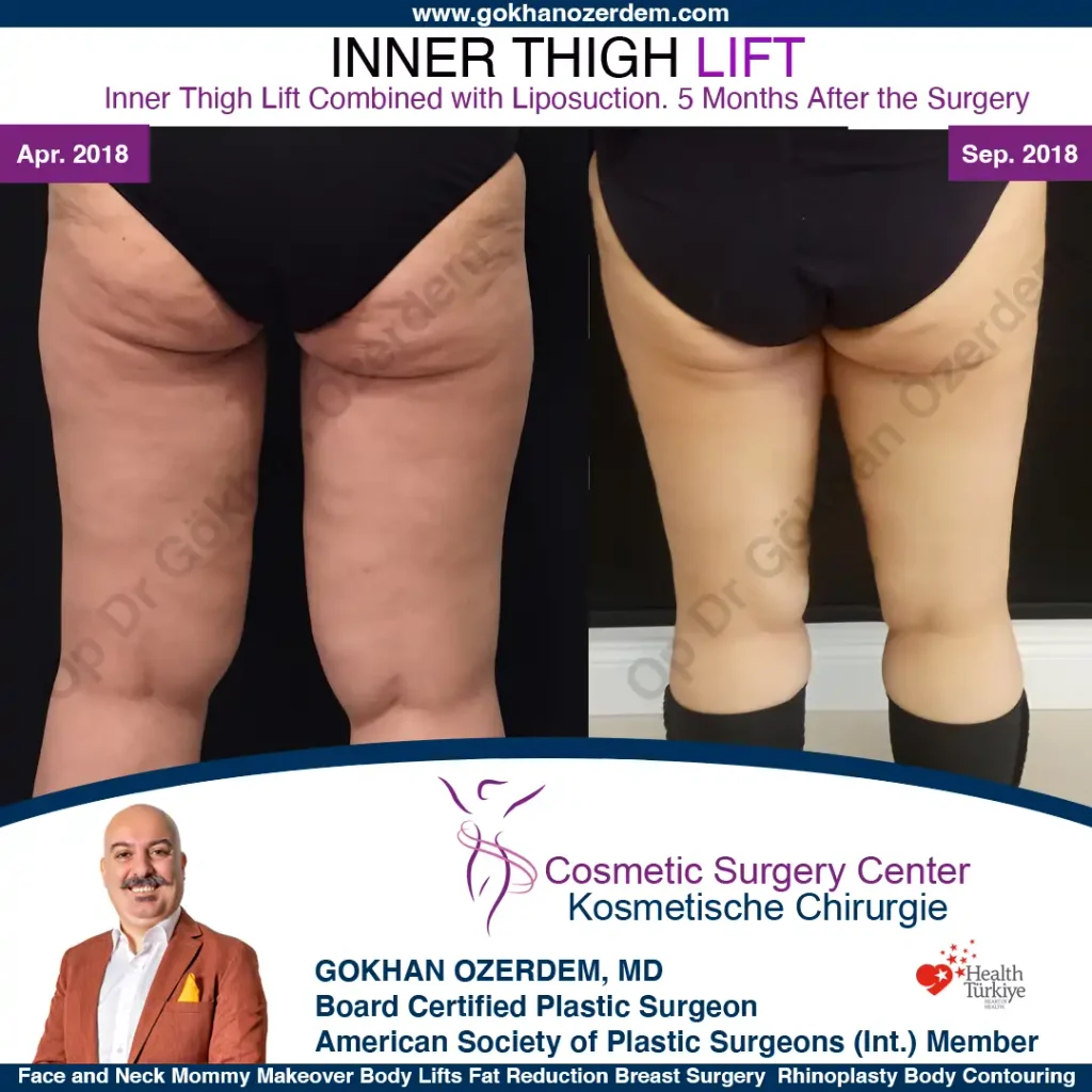 Inner Thigh Lift in Turkey, Antalya Case 1 - Back View