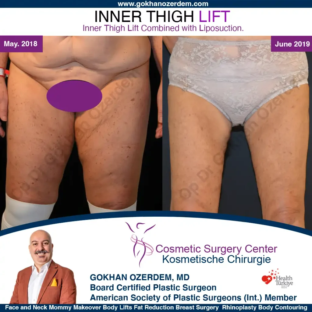 Inner Thigh Lift in Turkey, Antalya Case 3 - Front View