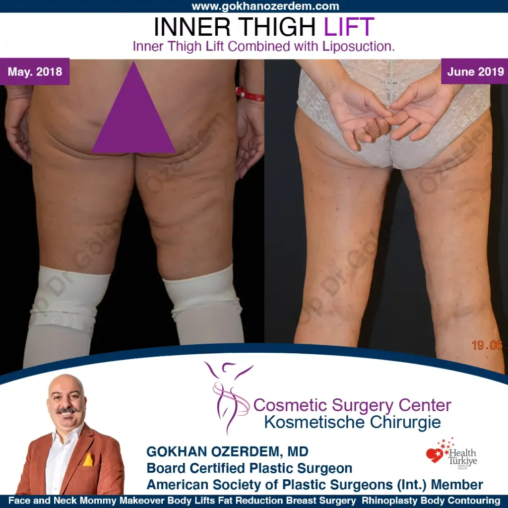Inner Thigh Lift in Turkey, Antalya Case 3 - Back View