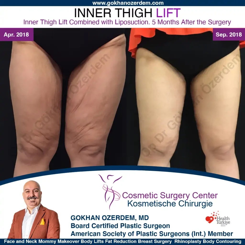 Inner Thigh Lift in Turkey, Antalya Case 1 - Front View