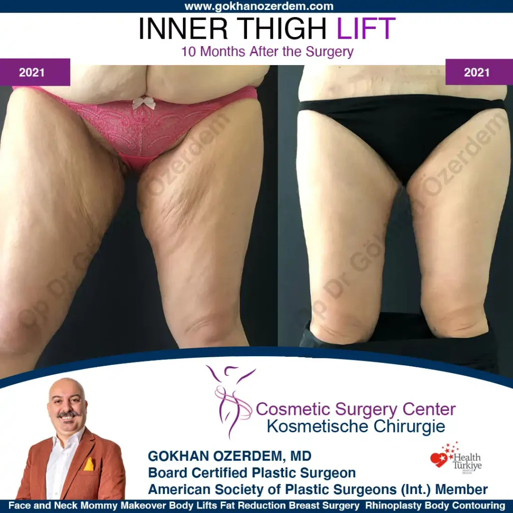 Inner Thigh Lift in Turkey, Antalya Case 2 - Front View