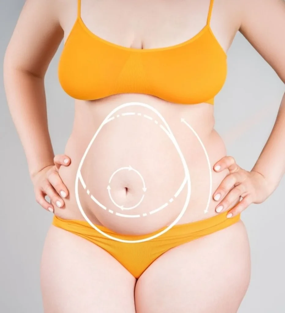 Mini Tummy Tuck in Turkey, Antalya