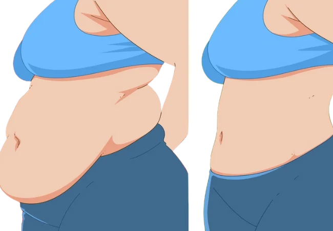 Tummy Tuck in Turkey Antalya Dr Gökhan Özerdem