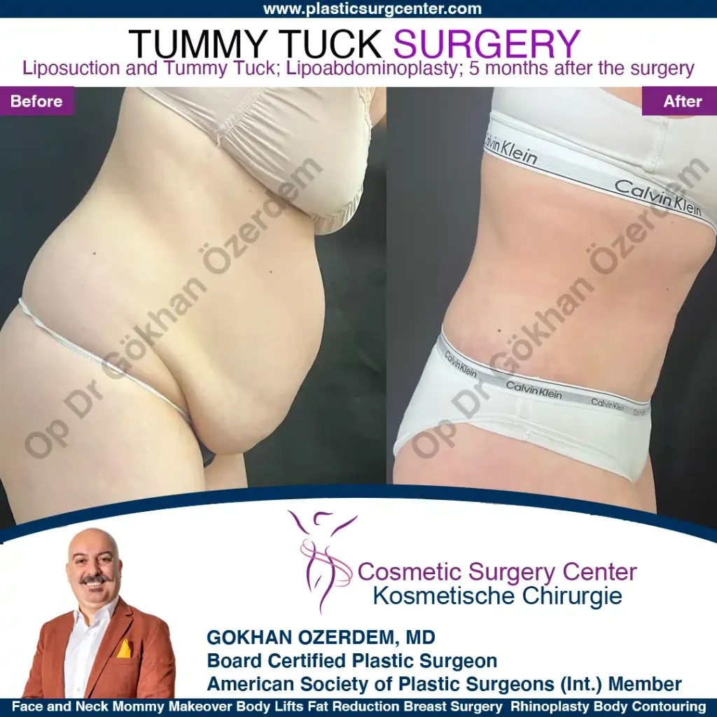 Tummy tuck in Turkey - Case 9 - Leaning Front