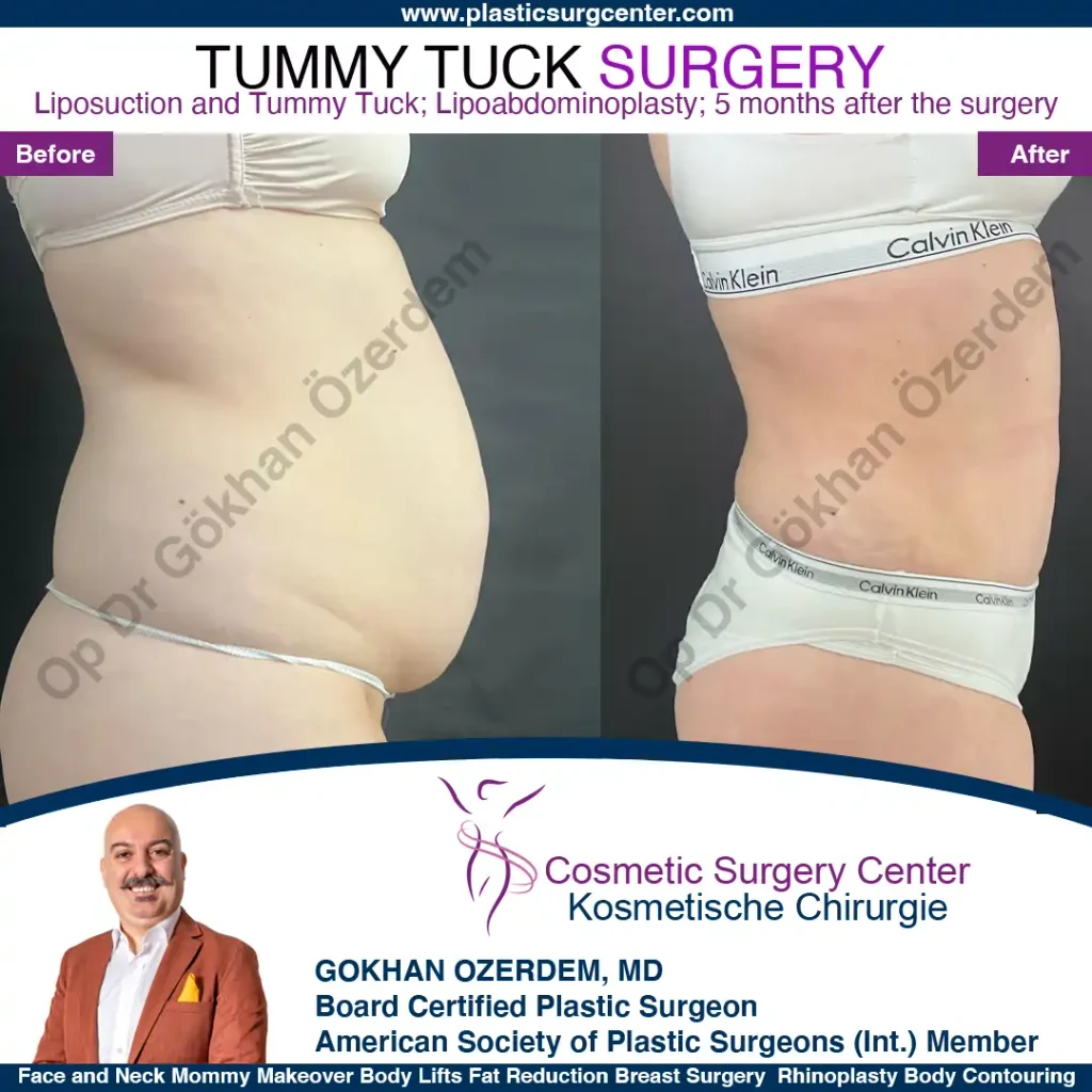 Tummy tuck in Turkey - Case 9 - Right Side