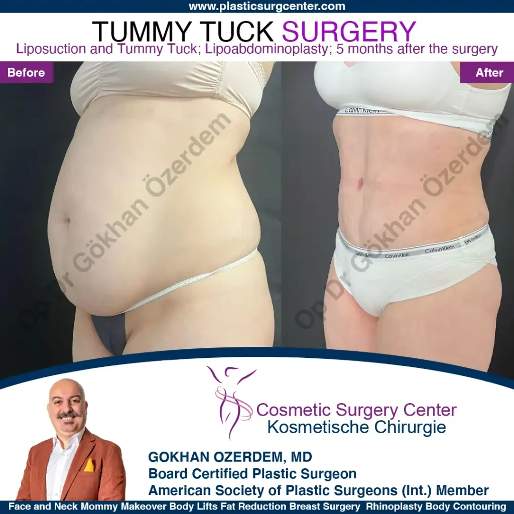 Tummy tuck in Turkey - Case 9 - Oblique View